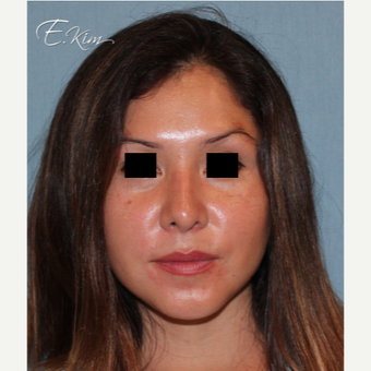 35-44 year old woman treated with Rhinoplasty after 3577982