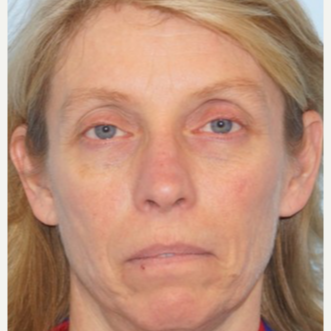 45-54 year old woman treated with Ptosis Surgery before 3727812