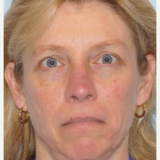 45-54 year old woman treated with Ptosis Surgery after 3727812