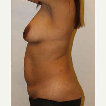45-54 year old woman treated with Mommy Makeover before 3372621