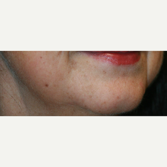 55-64 year old woman treated with Injectable Fillers before 3425560