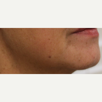 55-64 year old woman treated with Injectable Fillers after 3425560