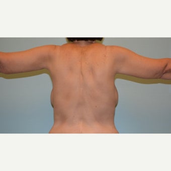 Arm lift and Mastopexy (breast lift) with implants on 55 year old gastric bypass patient 1829707