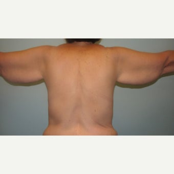 Arm lift and Mastopexy (breast lift) with implants on 55 year old gastric bypass patient 1829707