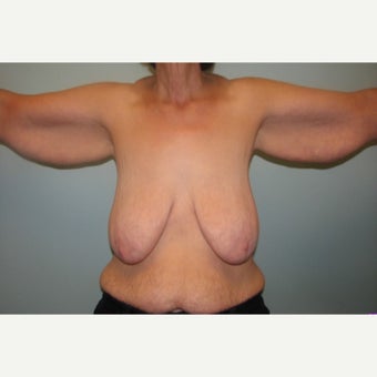 Arm lift and Mastopexy (breast lift) with implants on 55 year old gastric bypass patient before 1829707