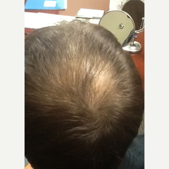 35-44 year old woman treated with ARTAS Robotic Hair Transplant before 3103786