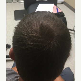 35-44 year old woman treated with ARTAS Robotic Hair Transplant after 3103786