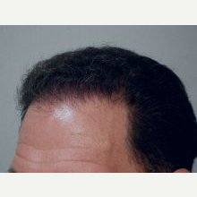 Hair Transplant after 3241442