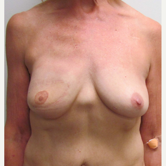 Breast Reconstruction Revision for this 60 Year Old Woman before 3093467