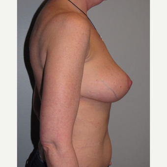 45-54 year old woman treated with Breast Reduction after 3663517