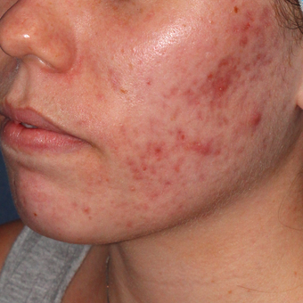 20 year old woman treated with PDT for severe scarring acne before 3076863