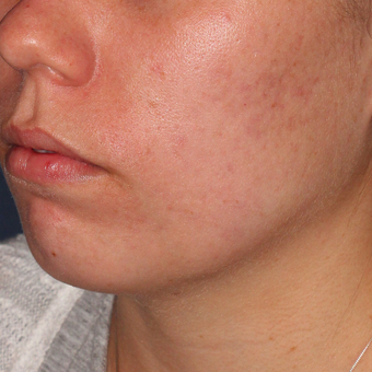 20 year old woman treated with PDT for severe scarring acne after 3076863