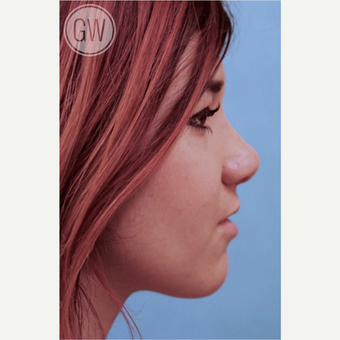 18-24 year old woman treated with Nose Surgery after 3477944