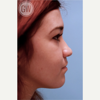 18-24 year old woman treated with Nose Surgery before 3477944
