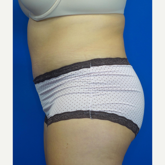 35-44 year old woman treated with Tummy Tuck after 3769563