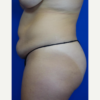 35-44 year old woman treated with Tummy Tuck before 3769563