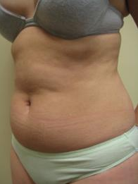29 year old female before and after SmartLipo of the abdomen 626263
