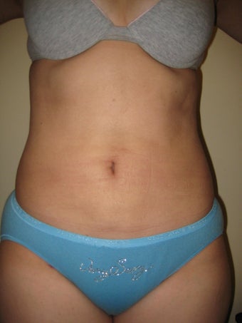 29 year old female before and after SmartLipo of the abdomen after 626263