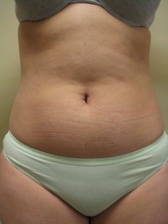 29 year old female before and after SmartLipo of the abdomen before 626263