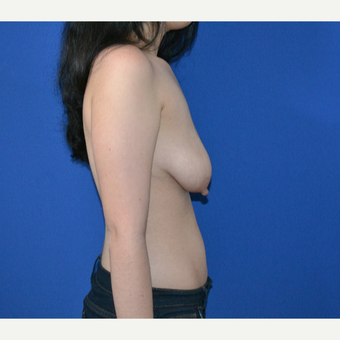 25-34 year old woman treated with Breast Lift before 3466570