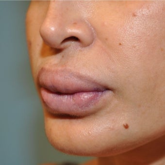 35-44 year old woman treated with Lip Reduction before 2080629