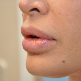 35-44 year old woman treated with Lip Reduction after 2080629