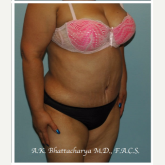 45-54 year old woman treated with Tummy Tuck after 3622310