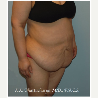 45-54 year old woman treated with Tummy Tuck before 3622310