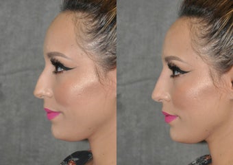 18-24 year old woman treated with Rhinoplasty after 3566976