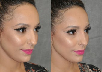 18-24 year old woman treated with Rhinoplasty before 3566976