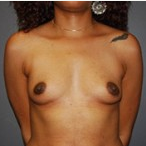 33 year old female receives Breast Implants before 3570257
