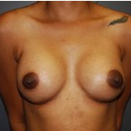 33 year old female receives Breast Implants after 3570257