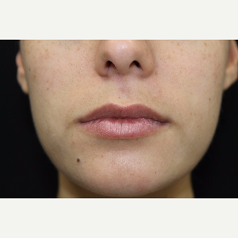 26 year old woman, lip augmentation with Juvederm before 2976655