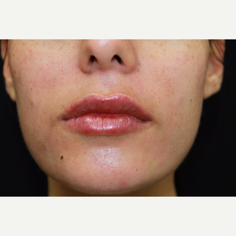 26 year old woman, lip augmentation with Juvederm after 2976655