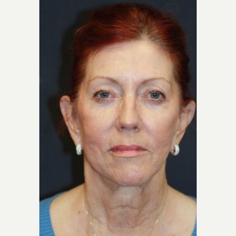66 year old woman treated with Juvederm after 3689852