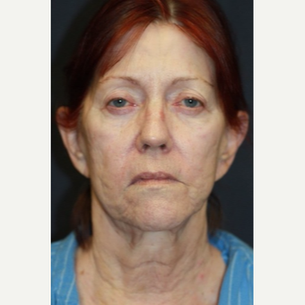 66 year old woman treated with Juvederm before 3689852
