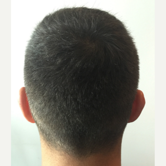 26 years old man treated with FUE Hair Transplant after 3068904