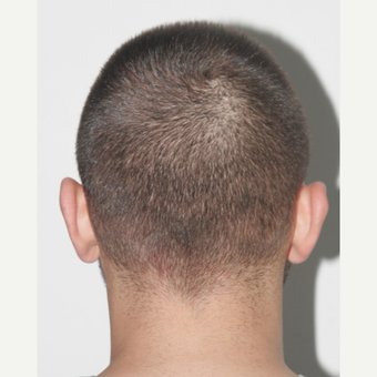 26 years old man treated with FUE Hair Transplant before 3068904
