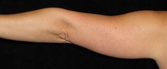 38 year old woman treated with Liposuction of Arms 3252419