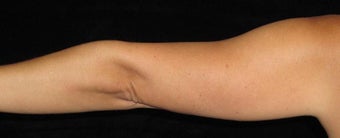38 year old woman treated with Liposuction of Arms 3252419