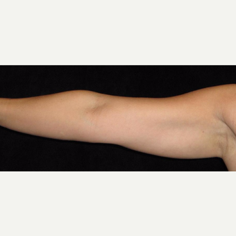 38 year old woman treated with Liposuction of Arms before 3252419