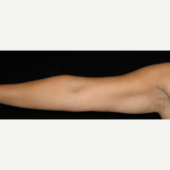 38 year old woman treated with Liposuction of Arms after 3252419