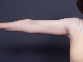 49 year old with sagging arm skin after 626304