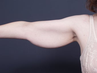 49 year old with sagging arm skin before 626304
