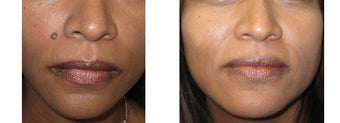 Mole Removal photos before 951880