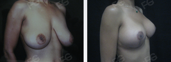 35 y/o patient who underwent a Breast Lift without implants 1403342