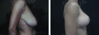 35 y/o patient who underwent a Breast Lift without implants after 1403342