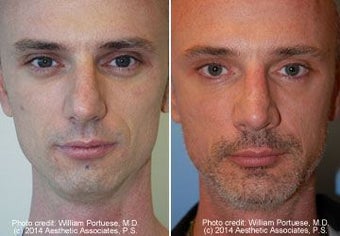 Rhinoplasty, Chin Implant before 91930