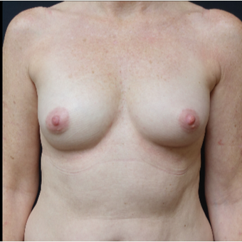 35-44 year old woman treated with Sientra Breast Implants before 3282536