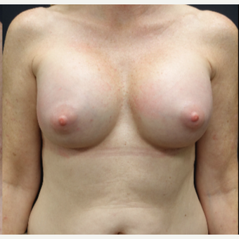35-44 year old woman treated with Sientra Breast Implants after 3282536